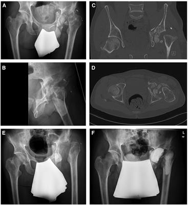 Case Report: Hip arthroplasty after fracture-related joint infection caused by extensively drug-resistant Klebsiella pneumoniae